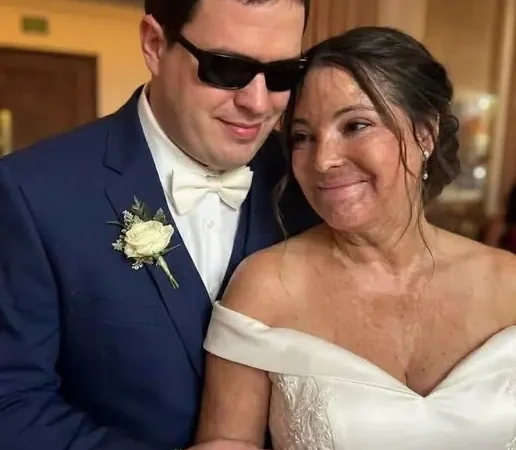 Elle a épousé un homme aveugle pour cacher ses cicatrices : le secret qu’il lui a révélé le soir de leurs noces a tout bouleversé