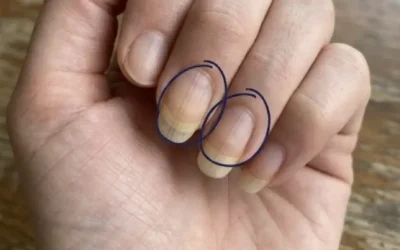 Si vous avez des stries sur vos ongles en voici la signification.jpg (1)