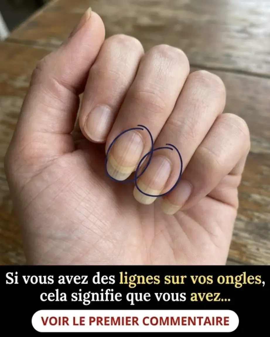Si vous avez des stries sur vos ongles en voici la signification.jpg (1)
