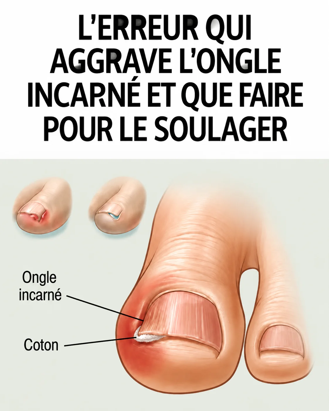 Soulager un ongle incarné correctement